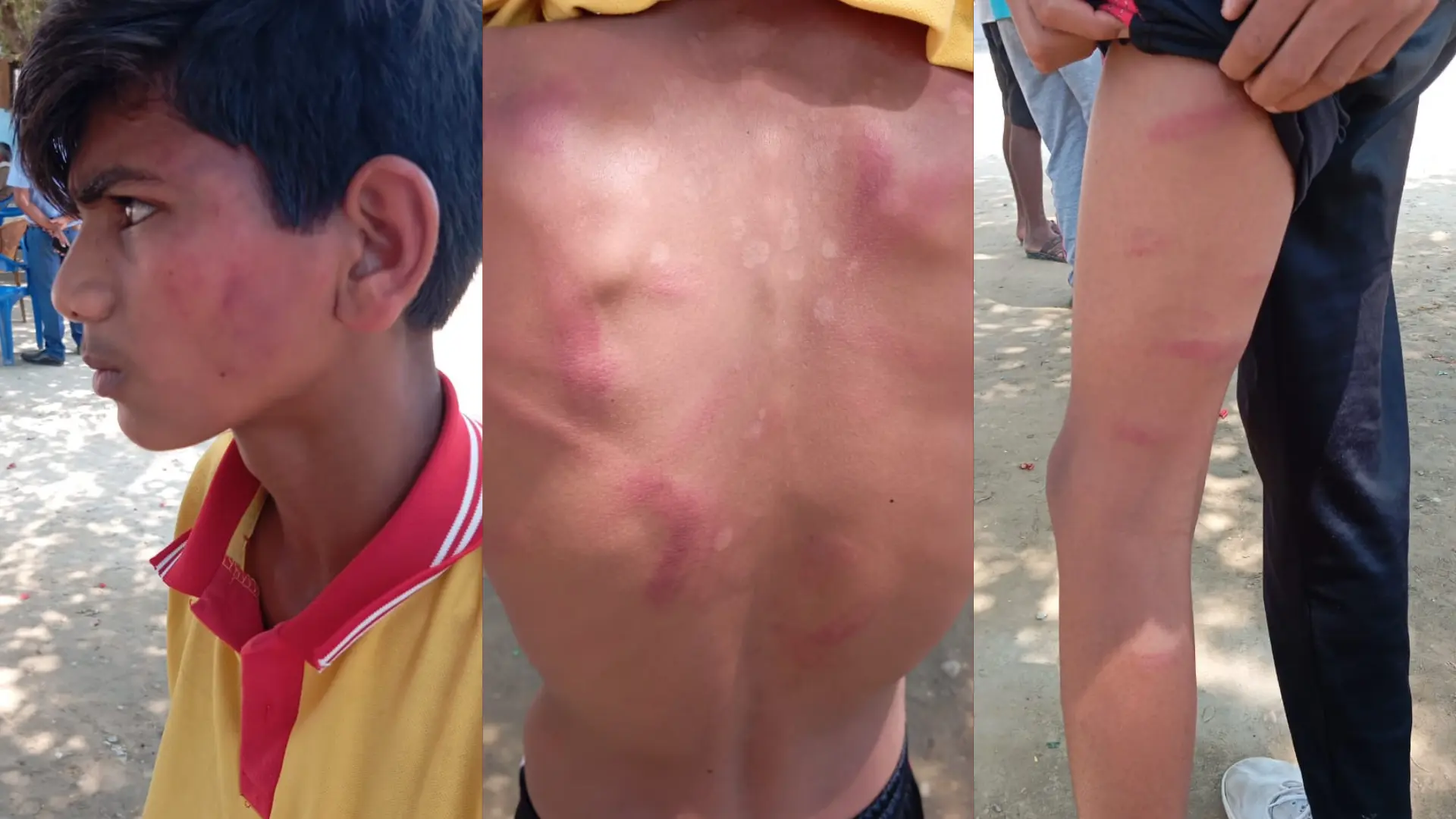 शिक्षकको कुटाइबाट १३ वर्षिय विद्यार्थी अविनास अस्पताल भर्ना